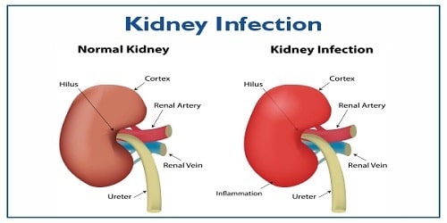 Difference Between Kidney Infection and Urinary Tract Infection