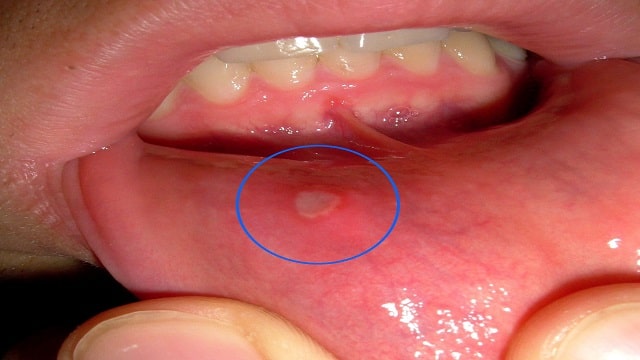 Ulcers in the Gums