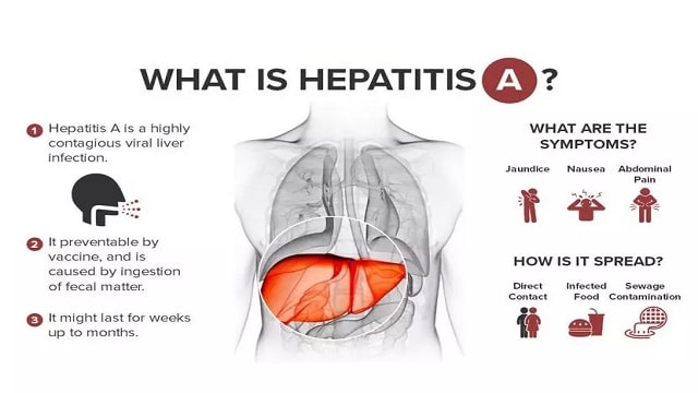 Hepatitis A